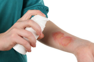 person spraying medicine on burn injury