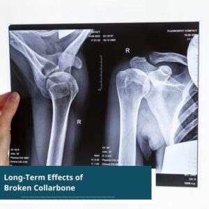 broken collarbone - long term effects of broken collarbones