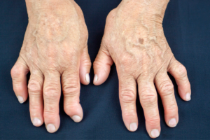 hands with a Rheumatoid Arthritis - the person is filling for an SSDI claim